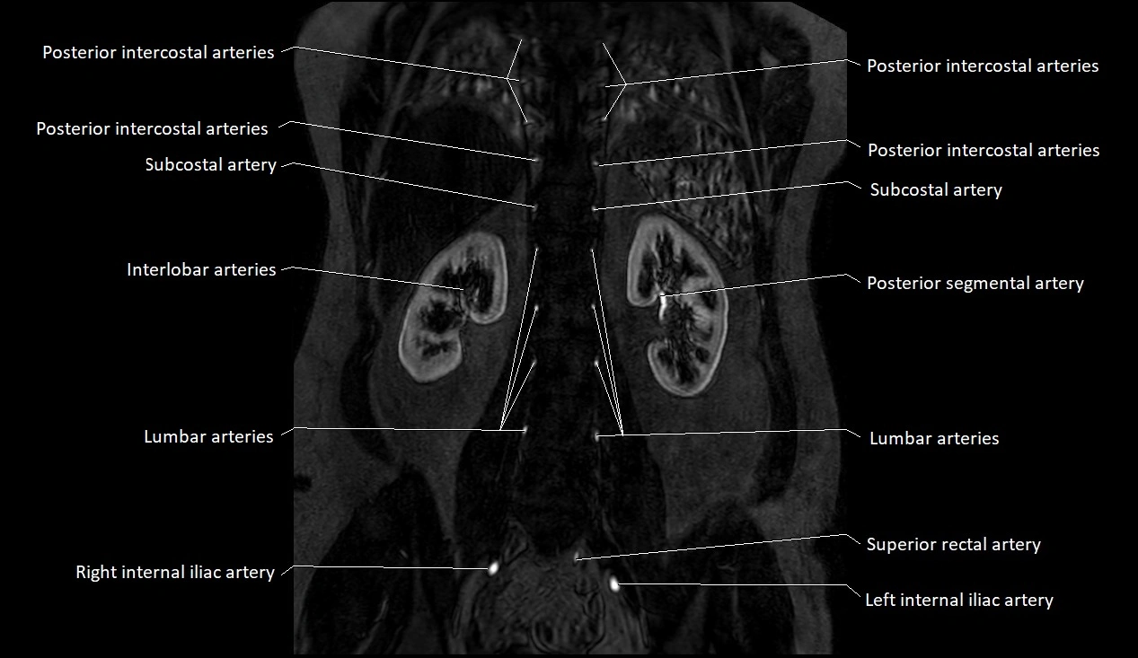 MRA Abdomen coronal anatomy image 42.webp